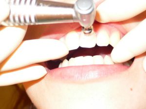 銀座　歯のクリーニング